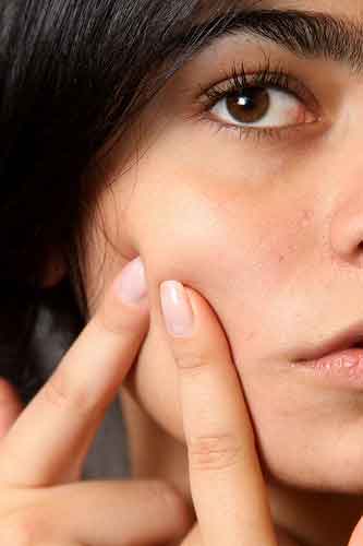 A tener en cuenta para evitar los brotes de acné
